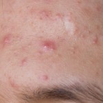 acne_forehead_men_image_skin_dylan_stein_acupuncture_nyc image man forehead acne pimples