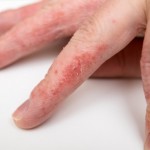 hand_eczema_dylan_stein_acupuncture_newyorkcity Hand eczema pompholyx cheiropompholyx eczema