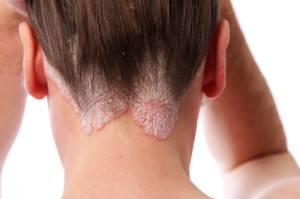 Psoriasis on the hairline and scalp psoriasis on the scalp and hairline