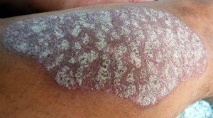 Psoriasis white scale lesion on the arm psoriasis white scale lesion arm purple skin
