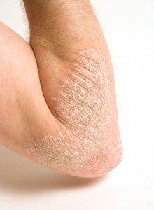 Psoriasis on the elbow with white scale picture of psoriasis lesion on the elbows with white scale and redness