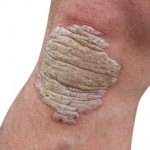 Psoriasis on a man's knee